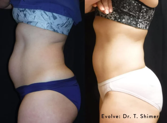 evolve-before-after-dr-t-shimer-preview-1
